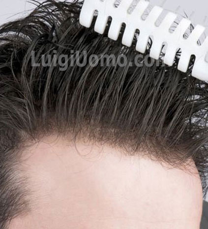 10-infoltimento-capelli-a-Frosinone Latina Rieti Roma Viterbo-per-uomo-donna-non-chirurgico-