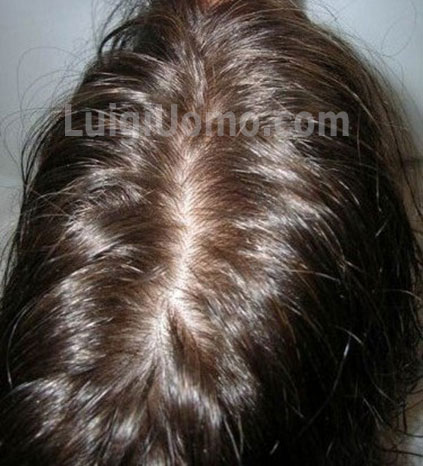 11-infoltimento-capelli-a-Frosinone Latina Rieti Roma Viterbo-per-uomo-donna-non-chirurgico-
