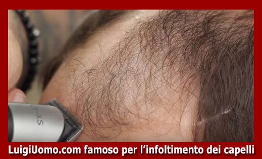 17-Protesi-capelli-a-Treviso-per-uomo-donna-infoltimento-capelli-impianti-capillari-patch-cutanea-membrana-capillare-