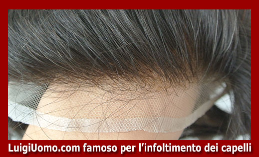 Patch cutanea, Prezzi e costi degli impianti capillari e protesi capelli  per infoltimento capelli uomo e donna con capelli europei veri