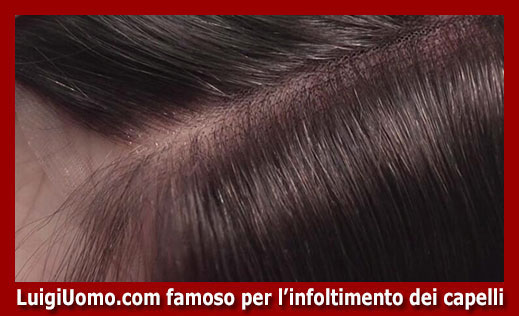 102-protesi-capelli-a-veri costi-per-uomo-donna-infoltimento-capelli-impianti-capillari-patch-cutanea-membrana-capillare-