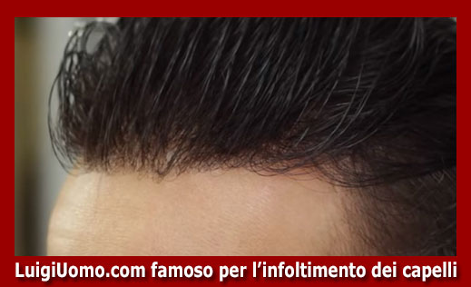 20-Protesi-capelli-a-L'Aquila-per-uomo-donna-infoltimento-capelli-impianti-capillari-patch-cutanea-membrana-capillare-