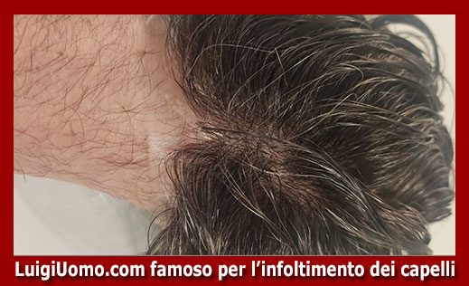 11-protesi-capelli-lace-a-Palermo-per-uomo-donna-infoltimento-capelli-impianti-capillari-patch-cutanea-membrana-capillare-