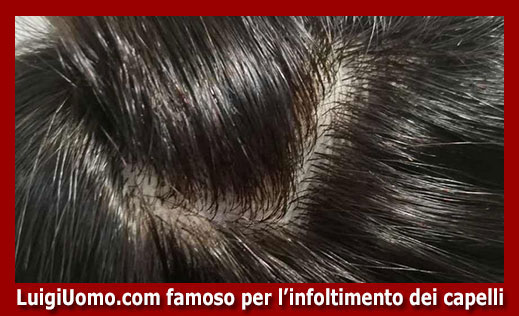 8-Protesi-capelli-a-Sestri Levante-per-uomo-donna-infoltimento-capelli-impianti-capillari-patch-cutanea-membrana-capillare-