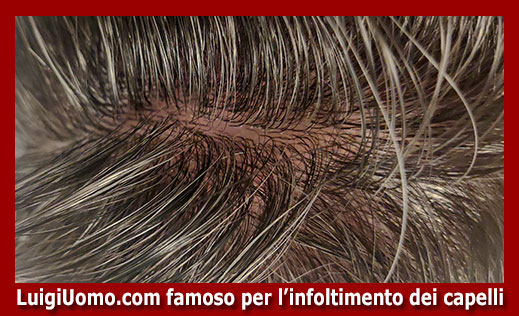 12-Protesi-capelli-a-Mazara del Vallo-per-uomo-donna-infoltimento-capelli-impianti-capillari-patch-cutanea-membrana-capillare-