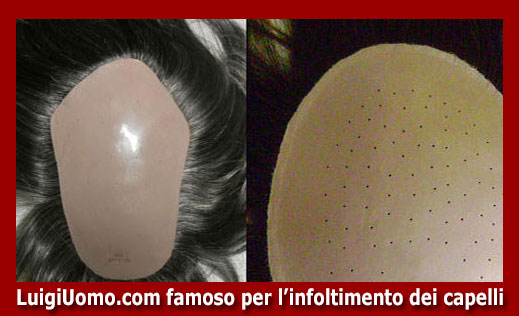13-protesi-capelli-lace-a-Frosolone-per-uomo-donna-infoltimento-capelli-impianti-capillari-patch-cutanea-membrana-capillare-