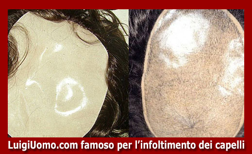 15-protesi-capelli-lace-a-Frosolone-per-uomo-donna-infoltimento-capelli-impianti-capillari-patch-cutanea-membrana-capillare-