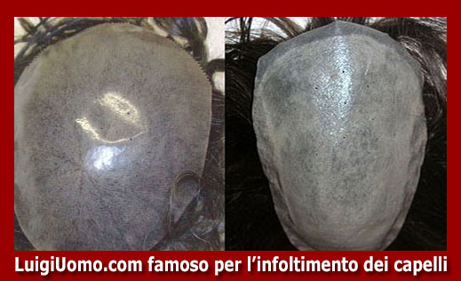 1102-protesi-capelli-a-Paternò-per-uomo-donna-infoltimento-capelli-impianti-capillari-patch-cutanea-membrana-capillare-